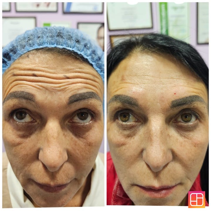 Результаты процедур — до и после