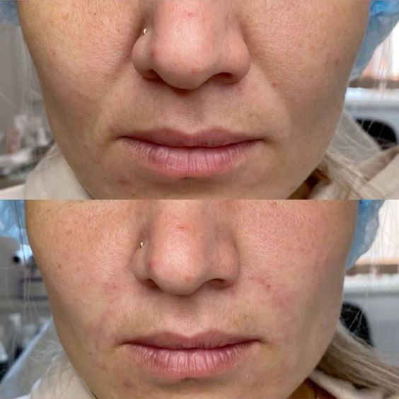 Результаты процедур — до и после